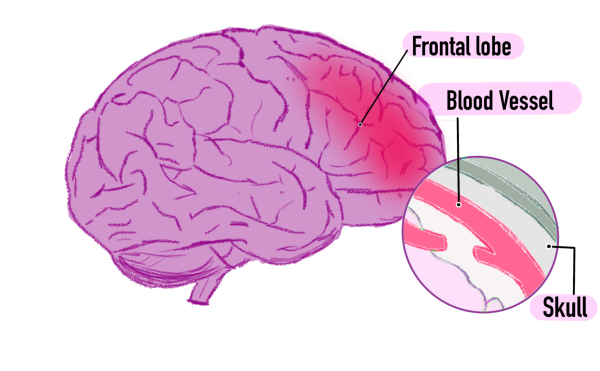 Many are aware of the pain that concussions cause on the court, but the arduous process of concussion recovery behind the scenes is less known. Apart from the initial pain of the hit, symptoms of a concussion vary and have the potential to heavily affect day-to-day cognitive function, emotional wellness and physical health. 